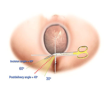 Episcissors-60 give an episiotomy at 60 degrees to the midline at crowning.