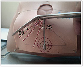 Angled EPISCISSORS-60 for epissiotomy